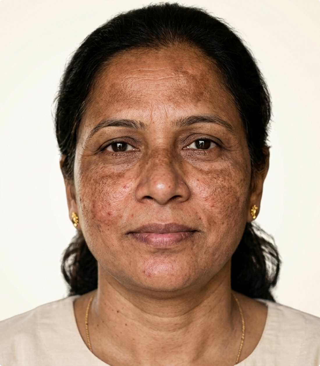 How diabetic skin needs a different kind of treatment